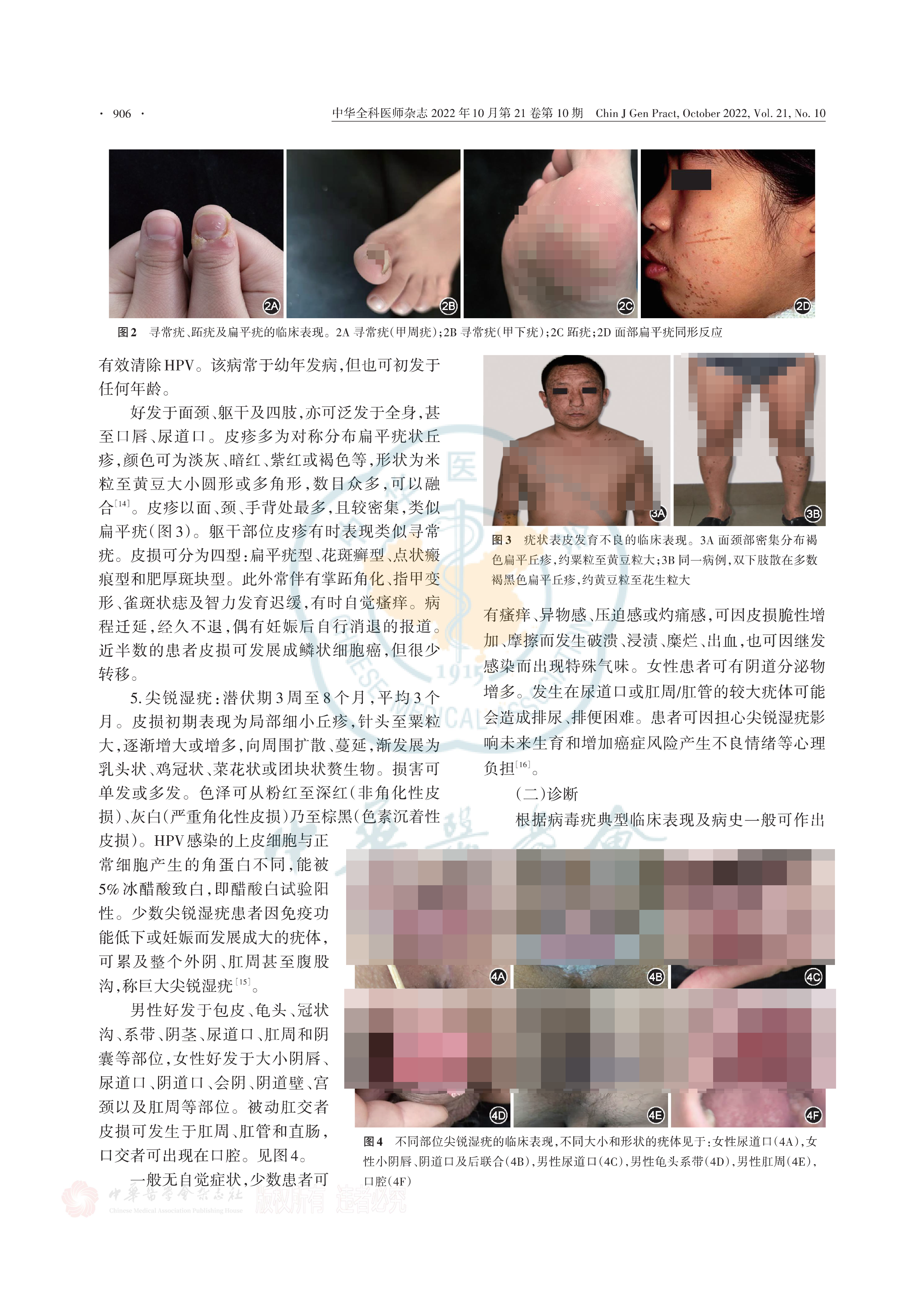 病毒疣基层诊疗指南（2022年）-3.png
