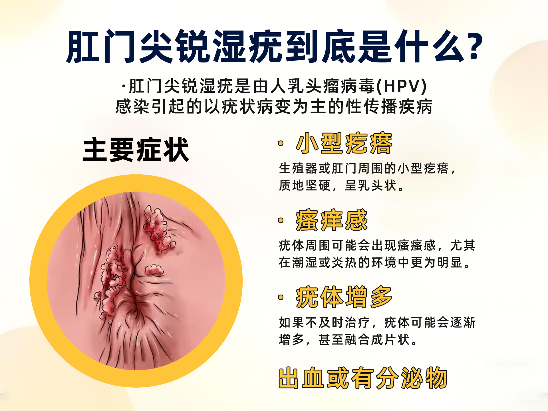 肛门尖锐湿疣的科普与治疗
